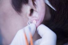 Auriculartherapy ear seed treatment. Courtesy Edward Olive/Dreamstime.com